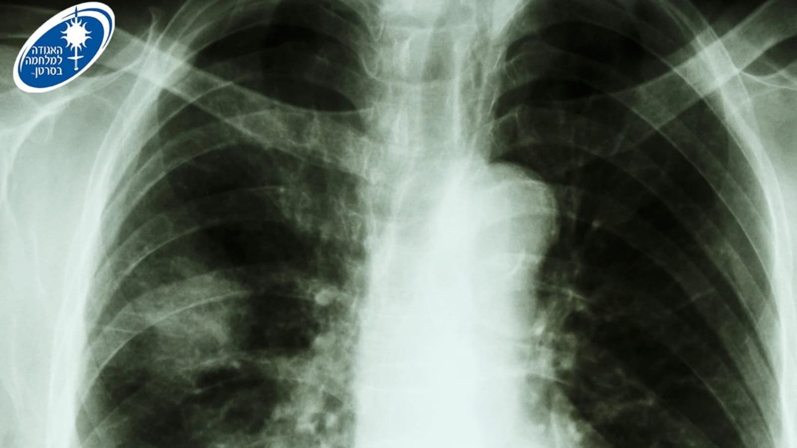 מחקר ב-NEJM: שילוב giredestrant הפחית ב-62% את הסיכון להתקדמות בסרטן שד עם מוטציית ESR1